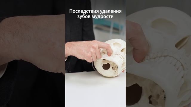 Какие последствия, если удалять зубы мудрости