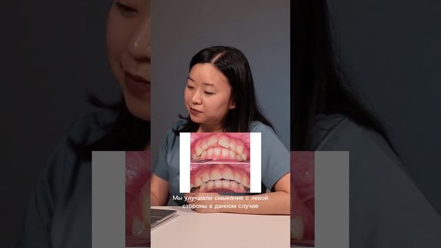 РАЗБОР случая: коррекция центральной линии и создание места под имплантацию. #брекеты #ортодонт