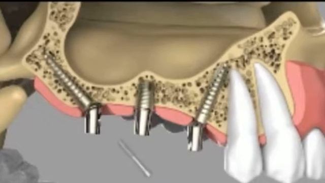 что такое мост на имплантах смотреть онлайн
