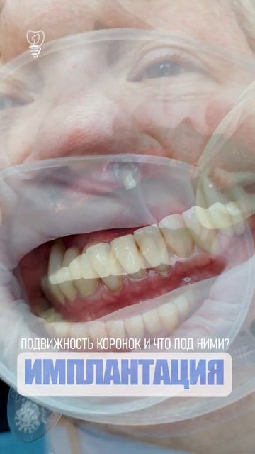 Подвижность коронок и что под ними? Mobility Of Crowns And What Is Underneath Them?