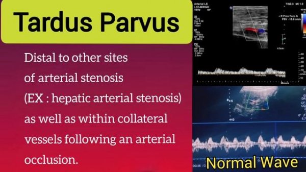 Renal Artery Stenosis - Tardus Parvus wave form - Diagnostic - Radiology