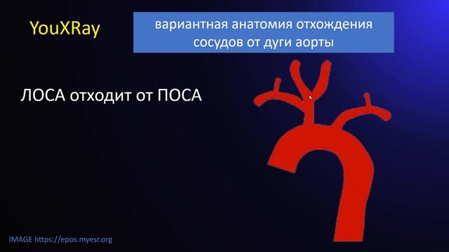 Вариантная анатомия отхождения сосудов от дуги аорты смотреть онлайн