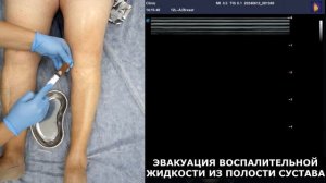 Пункция коленного сустава с УЗИ