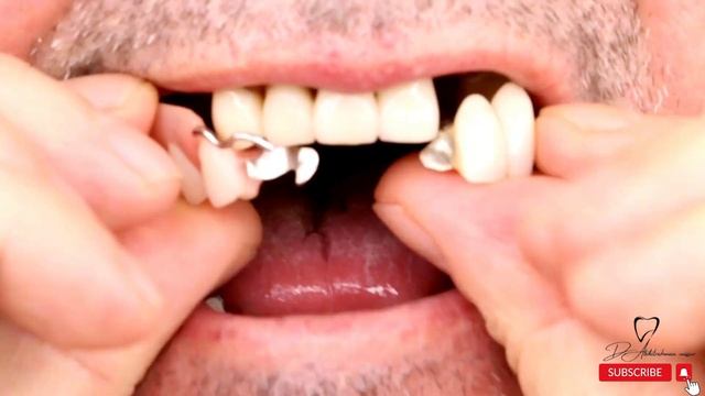 انواع التركيبات المتحركه للاسنان/تركيبات الاسنان/تركيبات الاسنان المتحركه смотреть онлайн