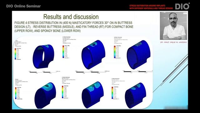 Stress Distribution Around Implants with Different Materials and Thread Designs by Dr. Faaiz смотреть онлайн