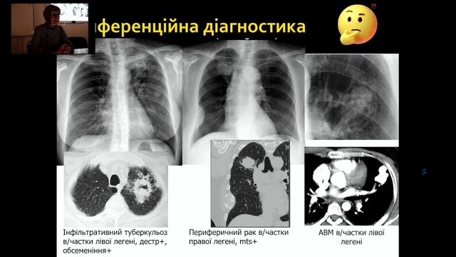 Можливості рентгенодіагностики легеневого туберкульозу