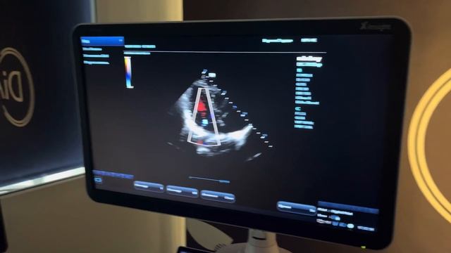 Обзор УЗИ аппаратов: Mindray DC 70 Pro, Alpinion Ecube8, SIUI 5800 и SIUI 5300. Сердце.