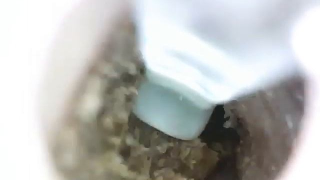 Dried Stubborn Ear Wax Extraction