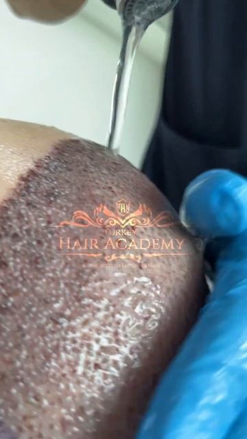 Как правильно убрать корочки с головы после операции. 👳♀️