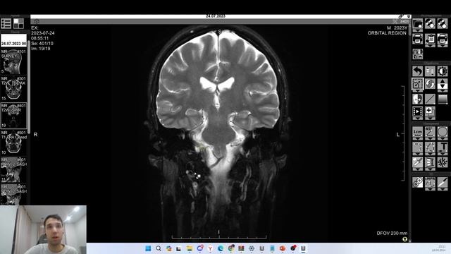 7 Заключений МРТ ВНЧС!!! Сравнение и обзор. Пациент М-28 смотреть онлайн