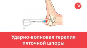 Ударно-волновая терапия пяточной шпоры