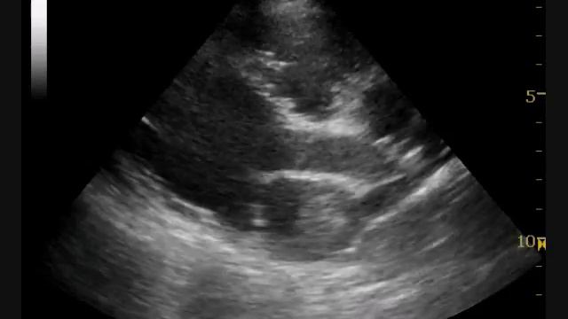 DCM Severe with LA thrombus смотреть онлайн
