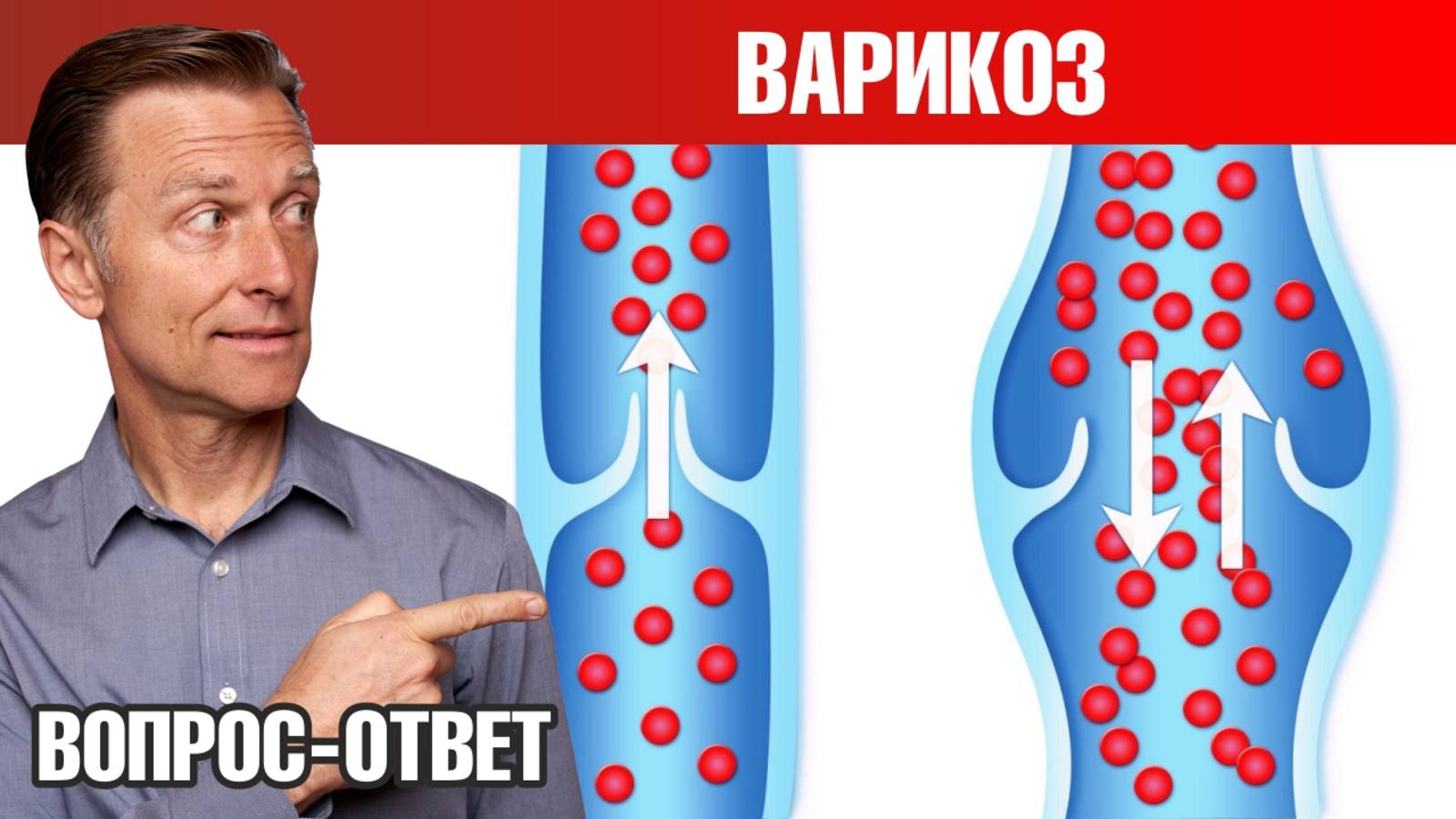 Как избавиться от варикоза 👉 лучший способ и профилактика смотреть онлайн