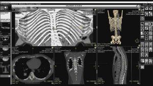 Обучающее видео. Программа «Ручная разметка позвоночника и Развертка ребер»