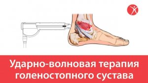 Ударно-волновая терапия голеностопного сустава в клинике Стопартроз