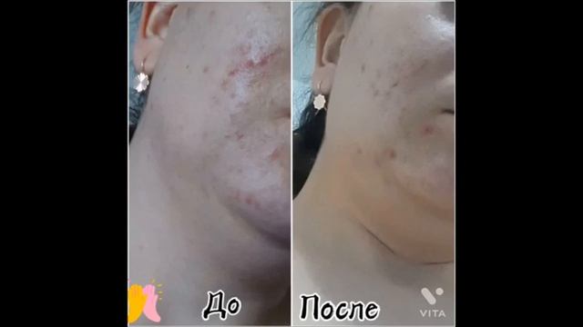 GemmaKorea - Королевский СЕТ, отзывы- до, после смотреть онлайн