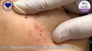 Удаляем чёрные точеки НОВОЕ! чистка лица от чёрных точек  Прыщи   выдавливание и удаление