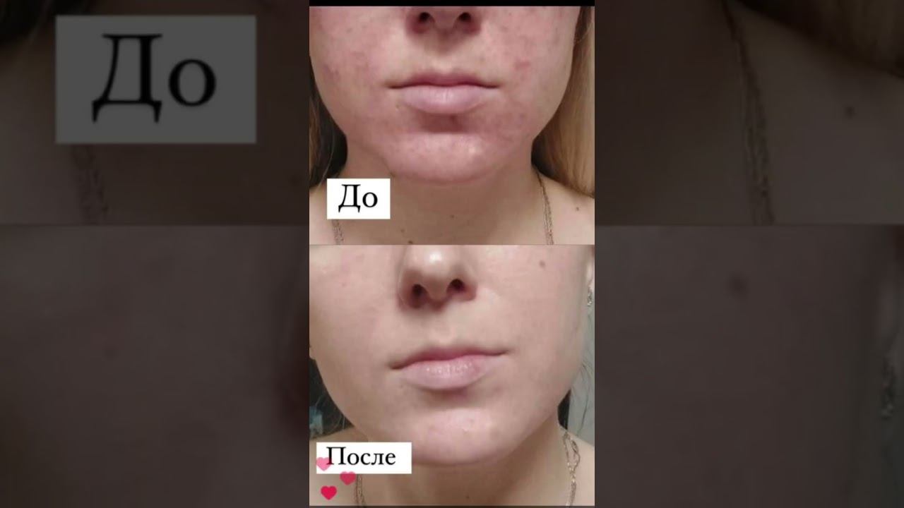 Работа с мышлением отражается на здоровье#коуч#коучинг#психосоматика#психика#здоровье#акне#развитие