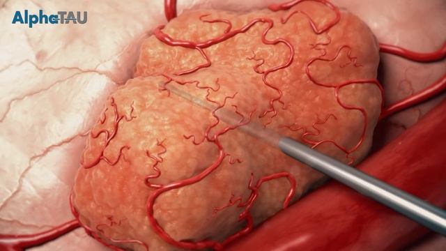 Alpha DaRT Cancer Treatment - Lili, BCC Cancer Patient