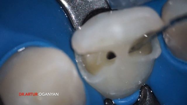 Лечение 22 зуба под микроскопом смотреть онлайн