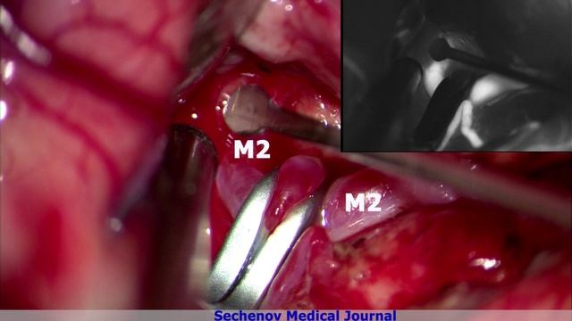 Microsurgical Clipping Of Aneurysms Of The Right Middle Cerebral Artery Bifurcation