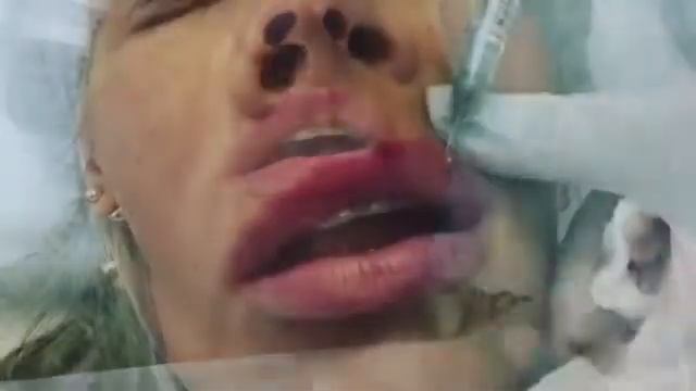 Увеличение губ смотреть онлайн
