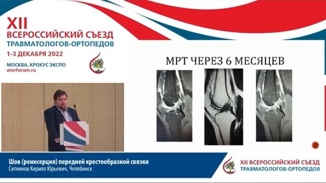 Шов (реинсерция) передней крестообразной связки Ситников Кирилл Юрьевич, Бельков В.Г., смотреть онлайн