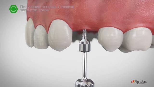 Получение оттиска в технике открытой и закрытой ложки l Alpha Bio Tec смотреть онлайн