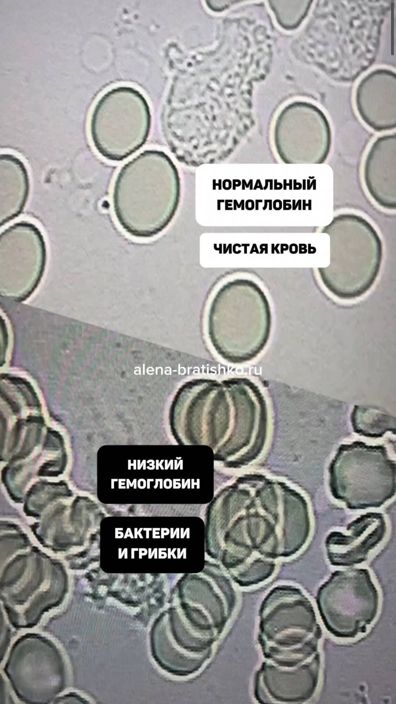 Бактерии и грибки в крови, низкий гемоглобин. Как должно быть? Алена Братишко смотреть онлайн