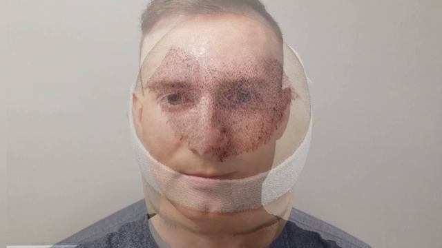 До и через год после пересадки волос в переднюю зону головы. смотреть онлайн