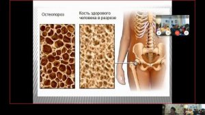 Вебинар : «Остеопороз, артроз, суставы, опорно двигательный аппарат, щитовидная железа. Часть 2»