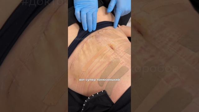 Комплексная операция — абдоминопластика, ушивание диастаза и пупочной грыжи смотреть онлайн