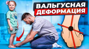 ВАЛЬГУСНАЯ ДЕФОРМАЦИЯ СТОПЫ / ЗАВАЛ СТОПЫ / КОРРЕКЦИЯ УПРАЖНЕНИЯМИ
