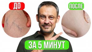 Не делай это при ВАРИКОЗЕ! Лечим варикоз ДОМА и без операций