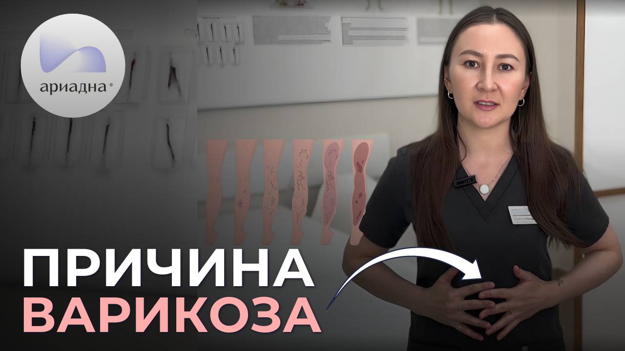 Варикоз: Чулки не помогут! Как остановить варикоз без операции? смотреть онлайн