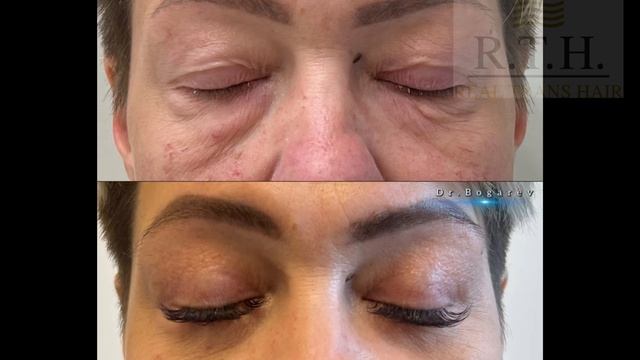 Блефаропластика или подтяжка бровей?
Какую операцию выбрать? смотреть онлайн