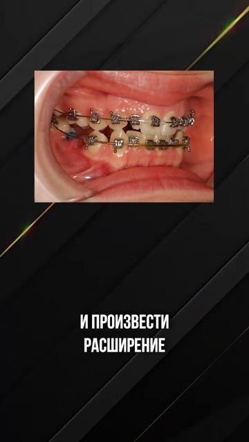 Ортодонтическое лечение. Брекет-система. Молочные зубы во взрослом возрасте.