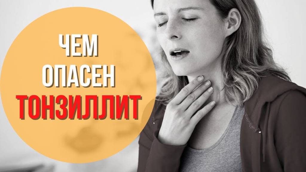 Как распознать тонзиллит. Можно ли вылечить хронический тонзиллит. Причины тонзиллита у взрослых смотреть онлайн