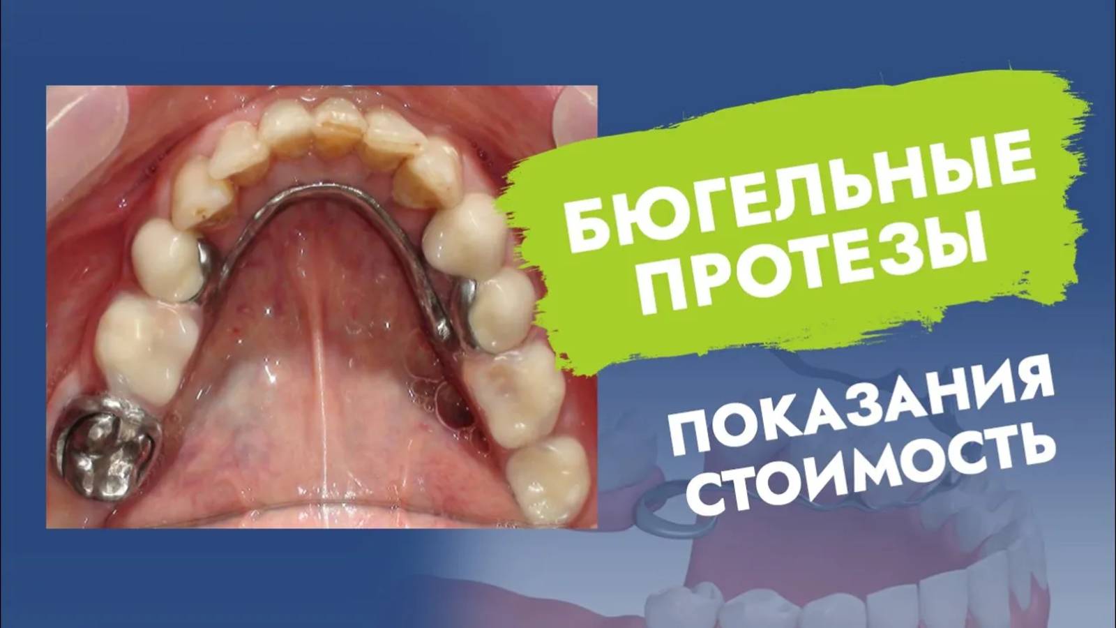 Бюгельный зубной протез. Показания и противопоказания. Стоимость!