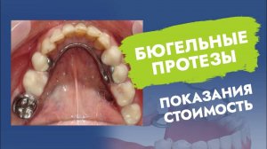 Бюгельный зубной протез. Показания и противопоказания. Стоимость!