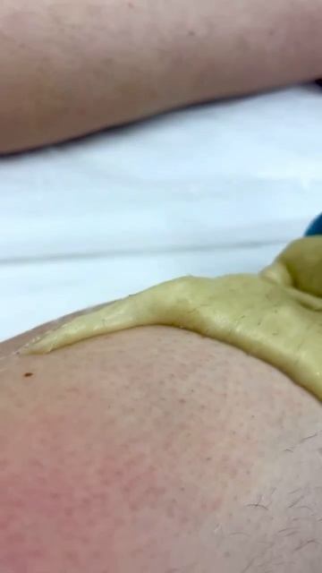 Шугаринг в Epil Story #лазернаяэпиляция #депиляция #электроэпиляция #косметология смотреть онлайн