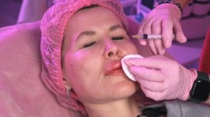 удаление филлера с губ