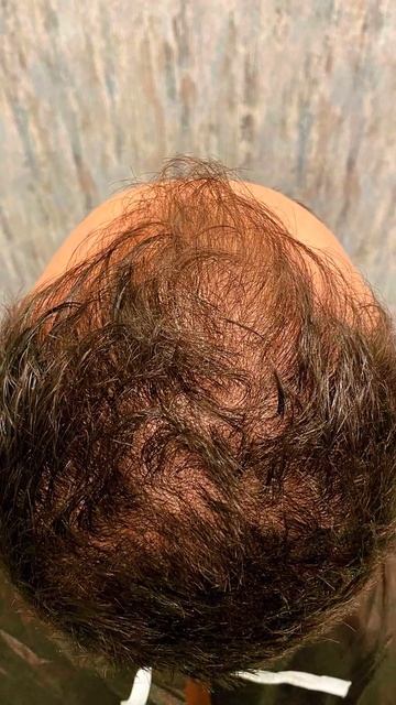 Пересадили 4.700 графтов FUE. Пересадка волос.#стамбул #ту? смотреть онлайн