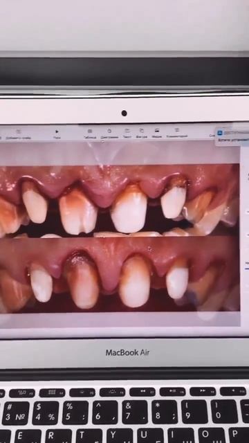 Интересный Тотал сейчас в работе , хирургическая плас?