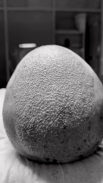 Пересадка волос в Москве #пересадкаволос #пересадкабр