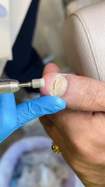 Как собрать анализ на грибок 🍄? смотреть онлайн