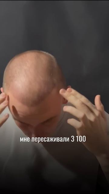 Приятный отзыв после пересадки волос ☺️