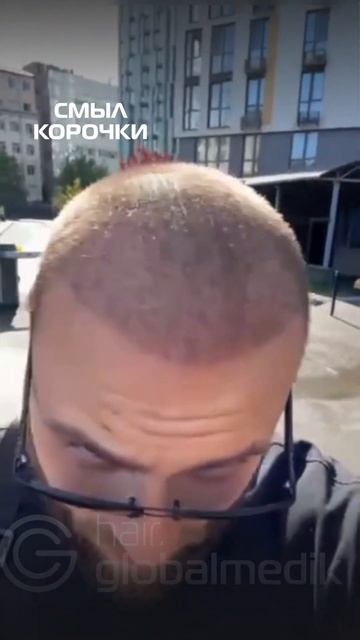 Мой опыт пересадки волос в Турции! #globalmedik #пересадкаво