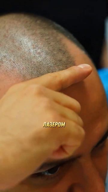 Артур Арутюнян пересадка в GGRAFT #пересадкаволосмосква