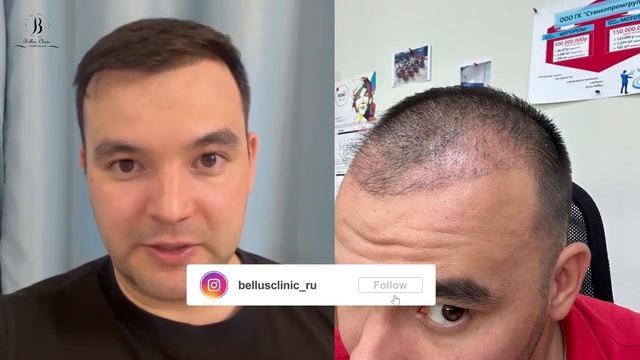 Результат пересадки волос и отзыв от Дениса смотреть онлайн